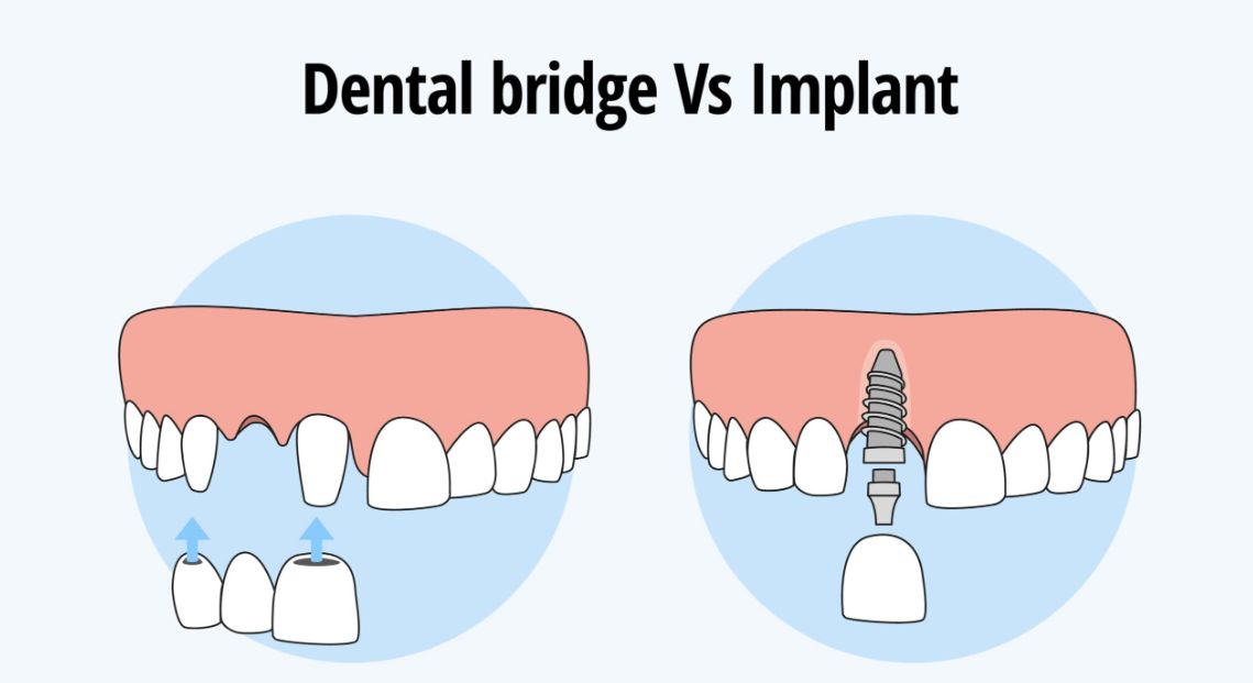 Dental bridges versus implants