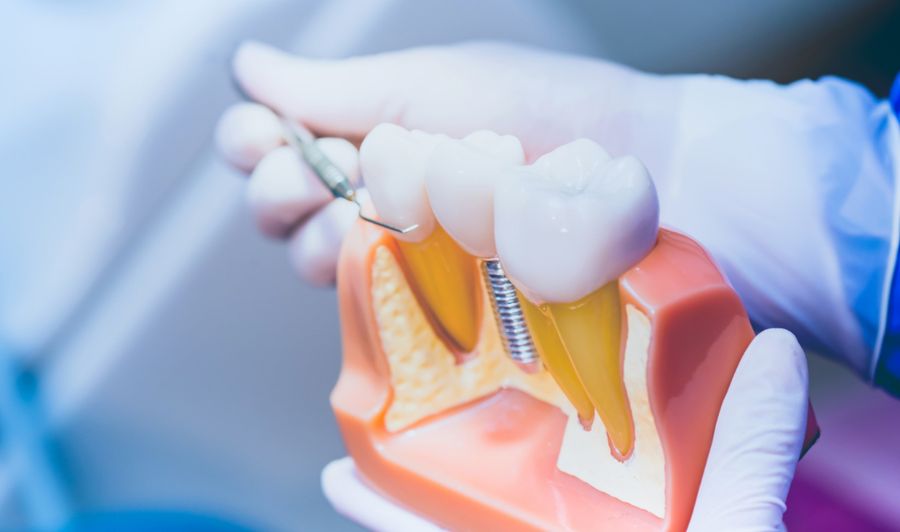 UK patient reviewing All-on-4 full arch restoration models and 3D jaw scans during a specialist consultation in a high-tech Budapest dental clinic.
