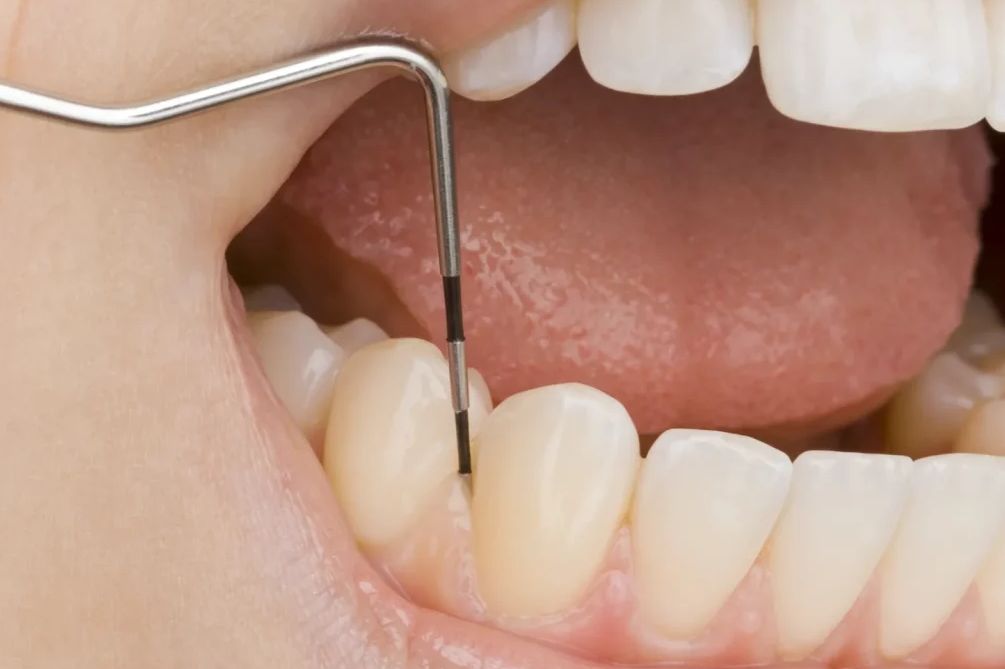 Gum and periodontal treatments Budapest, Hungary