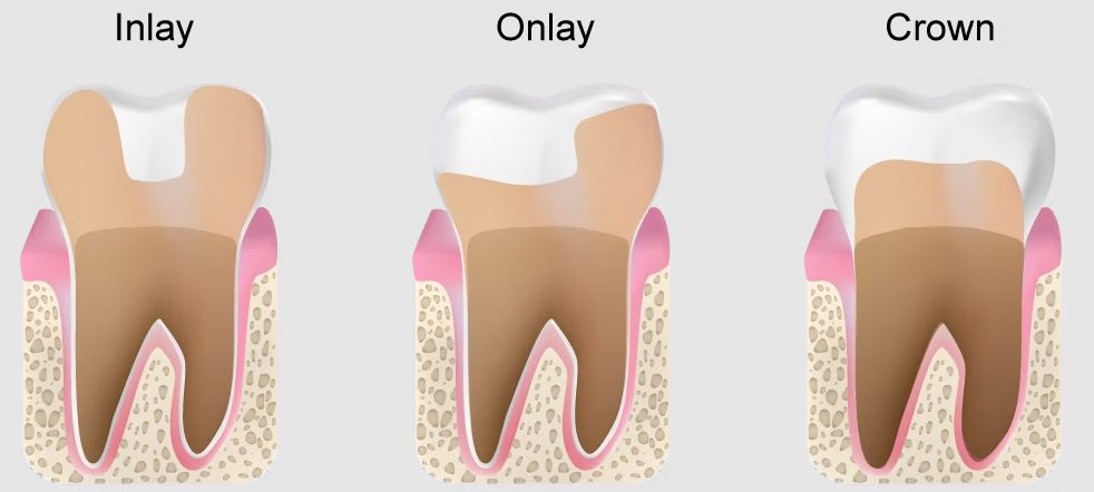 Inlays vs onlays vs crowns