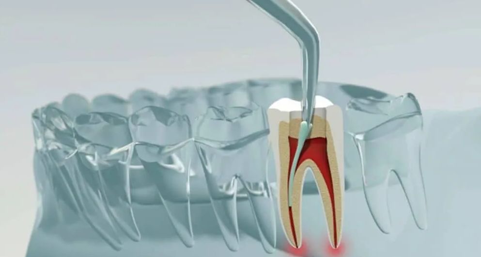 Root Canal treatment Budapest