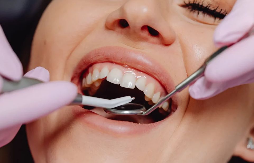 Tartar removal ultrasonic