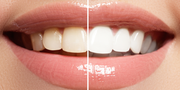Teeth whitening abroad: Budapest, Hungary
